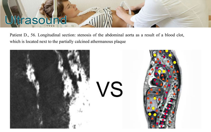 CERTAIN ASPECTS OF NLS-DIAGNOSTICS  OF LIVER FOCAL PATHOLOGY